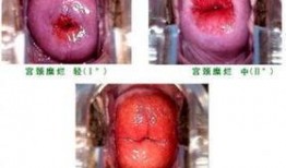 宫颈糜烂微波术视频,微波术治疗宫颈糜烂操作步骤详解