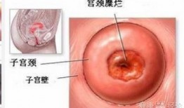 宫颈糜烂微波术视频,微波术治疗宫颈糜烂操作步骤详解